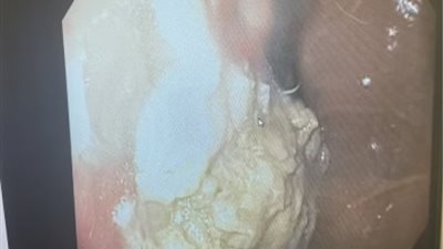 جراحة طارئة لطفل ابتلع 40 قطعة علكة