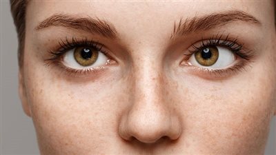 يورث من الأباء للأبناء.. أسباب الإصابة بالحول