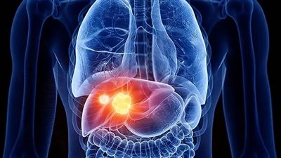 دراسة: المشروبات الخالية من السكر قد ترفع خطر الإصابة بأمراض الكبد