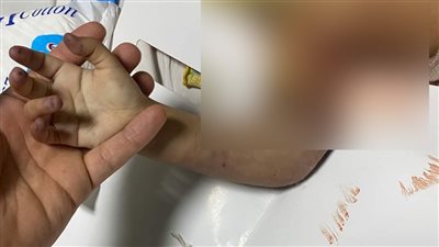 فريق بكلية طب سوهاج ينجح فى إنقاذ طفلة وضعت يدها داخل غسالة | صور