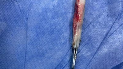 استخراج ملقاط شعر من القصبة الهوائية لشخص ابتلعه بالخطأ في القليوبية |صور 