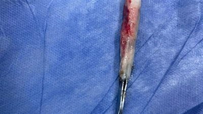 القليوبية ×24 ساعة| استخراج ملقاط شعر من القصبة الهوائية لمريض.. والتصريح بدفن نجار سقط من الطابق الرابع