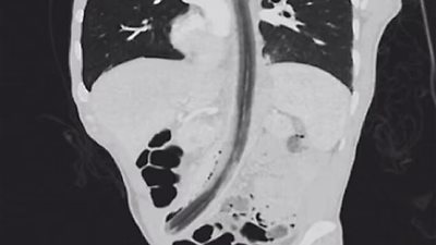 مصاب بـ الفصام النفسي.. رجل يخضع لجراحة طارئة بعد ابتلاعه عصا تهيأ له أن أصوات داخل رأسه تطلب ذلك