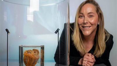 وجها لوجه.. سيدة تشاهد قلبها تالفا بمتحف بعد عملية زراعة ناجحة