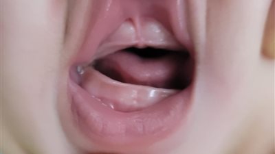 بعمر 6 أشهر.. أطباء الأقصر ينجحون في فتح فم رضيع لأول مرة بعد ولادته بجراحة نادرة