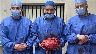 فريق طبي بمستشفيات جامعة أسيوط ينجح في استئصال ورم وزنه 12 كيلو من قولون مريضة