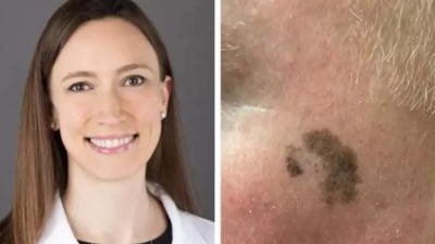 لديه شامة غريبة.. طبيبة جلدية تكتشف إصابة راكب بسرطان الجلد أثناء تواجدها في القطار