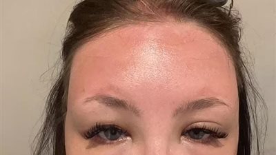 ديلي ميل: سيدة يتضاعف حجم وجهها بسبب إصابتها بتسمم الشمس