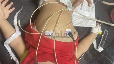 فريق طبي بمستشفى كفر الزيات بالغربية ينقذ طفلا رضيعا ابتلع قطعة بلاستيكية