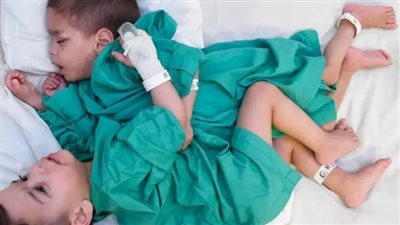 عملية جراحية معقدة.. الملك سلمان يوجه بإجراء جراحة فصل توأم سيامي سوري بالمملكة 