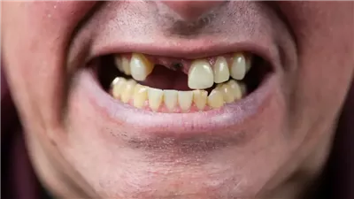 باحثون يابانيون يقتربون من ابتكار دواء يساهم في إعادة نمو الأسنان