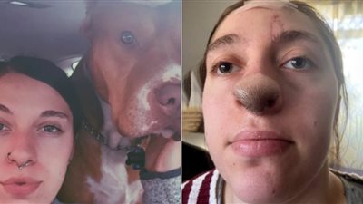 بسبب عضة كلب.. فتاة تتعرض لظاهرة طبية نادرة بعد ظهور شعر على أنفها