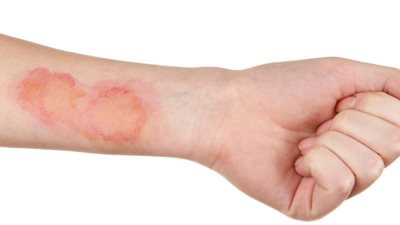 علامات غير شائعة للإصابة بسرطان الجلد