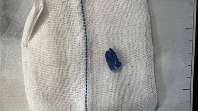 بلعت لبيسة قلم.. تفاصيل إنقاذ طفلة بجراحة عاجلة ببنها الجامعي بالقليوبية