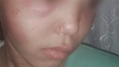 هربت من تعذيب زوج والدتها.. قرار جديد من جهات التحقيق في واقعة الطفلة جومانا بقنا