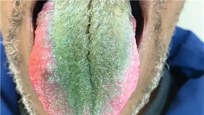 بسبب تدخينه للسجائر لسنوات.. نمو شعر أخضر في لسان مدخن أمريكي