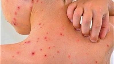 نصف سكان العالم معرضون لخطر الإصابة بحمى الضنك.. والصحة العالمية تطلق تحذيرًا