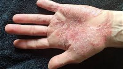 10 نصائح لمرضى الصدفية.. تعرف عليها