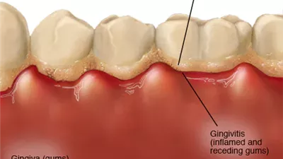 دراسة تكشف عن نظام غذائي صحي للثة 