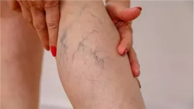 علاج الدوالي في المنزل.. تهدد الوجه والساقين وهذا علاجها ببساطة