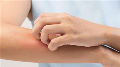 حكة وبقع وتصلب.. تعرف على تأثير مرض السكري على صحة الجلد