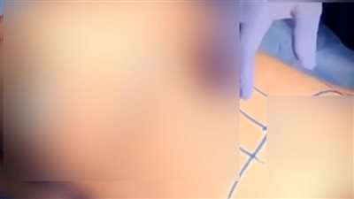 يُظهر جزءا حساسا من جسد السيدات.. فيديوهات دعائية لطبيب تجميل تثير غضب المواطنين