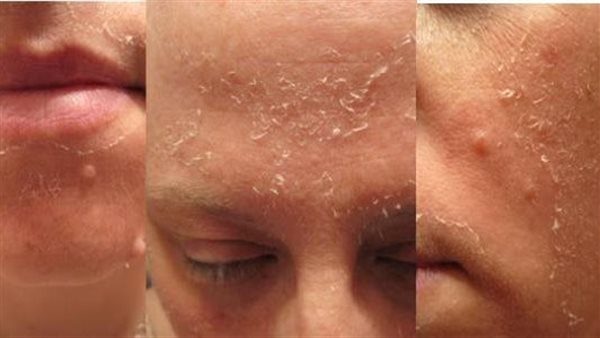 تقشير الوجه بعد المصيف