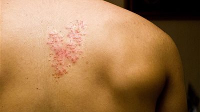 الصحة الأمريكية: ارتفاع أعداد الإصابات بحساسية القراد