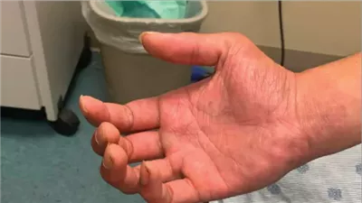 علماء يكتشفون حالة مصابة بمرض قاتل كان منتشرًا في العصور الوسطى