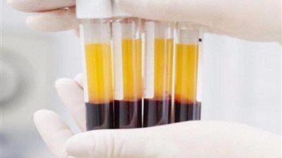 اكتشاف مؤشرات حيوية للبلازما تتنبأ بقضايا الصحة العقلية لدى المراهقين