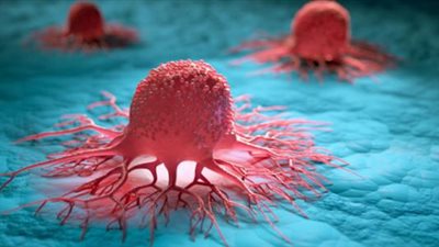 علماء يطورون تقنية جديدة لعلاج خلايا الأورام السرطانية | دراسة