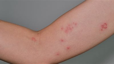 الصين تسجل حالتي إصابة بـ الطاعون الدبلي