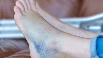 تغير لون القدم إلى الأزرق مرتبط بأعراض طويلة المدى بفيروس كورونا | دراسة 