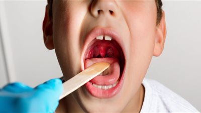 صعوبة التنفس والبلع.. تعرف على أضرار التهاب اللوزتين عند الأطفال