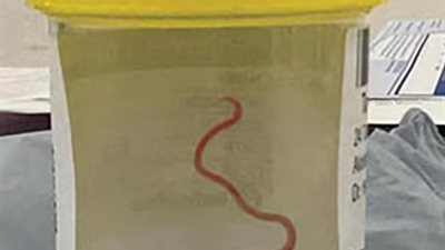 الاكتشاف الأول في العالم.. العثور على دودة حية بدماغ امرأة أسترالية