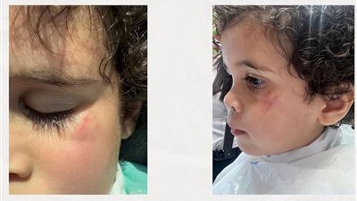 اتضرب واتعرض لأذى نفسي.. أم تشكو من إهمال حضانة شهيرة بمنطقة التجمع