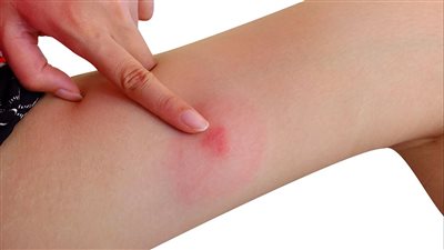 تجنب المواد الكميائية.. نصائح لعلاج الطفح الجلدي الناتج عن لدغات البعوض