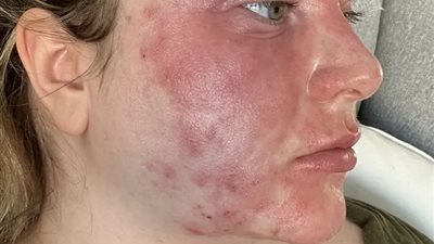 فتاة أجنبية تصاب بتشوهات في البشرة والعين بسبب لاصقات تبييض الأسنان