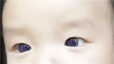 بسبب علاج كورونا.. عينا رضيع تتحول من البني الداكن إلى الأزرق الفاتح