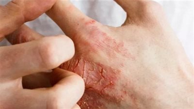 بدون أدوية.. دراسة تكشف فاعلية الصعقات الكهربائية في مكافحة العدوى البكتيرية 