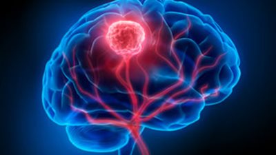دقة غير مسبوقة.. بحث جديد يشير إلى نقلة نوعية في علاج أورام المخ 