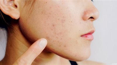 استشاري جلدية يكشف أضرار الضغط على البثور 