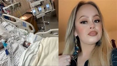 بسبب تناولها لـ سمك بلطي ملوث.. أمريكية تفقد جميع أطرافها 