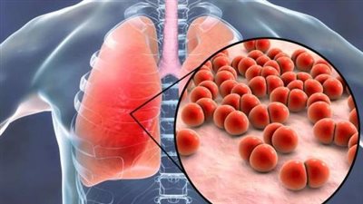 الصحة البريطانية: ارتفاع معدل الإصابة بالسل.. وهذه أعراض الإصابة بالمرض