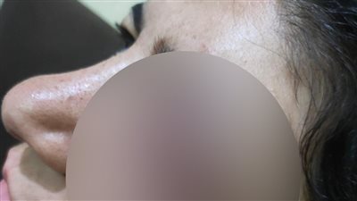 ممرضة السلام بعد فقء عينها: جاري ضربني لما ملقاش إخواتي.. والدكاترة قالولي مش هشوف تاني | صور