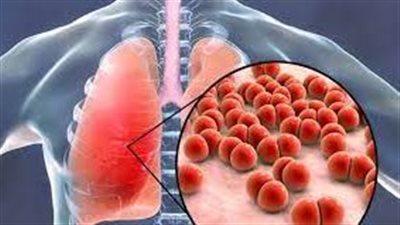 تجمعات البكتيريا الشبيهة بالحبل تسبب عدوى السل | دراسة