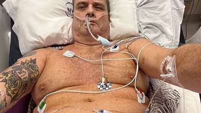 فتق وورم دموي.. رجل يصاب بمضاعفات خطيرة بعد التبرع بكليته لسيدة مسنة