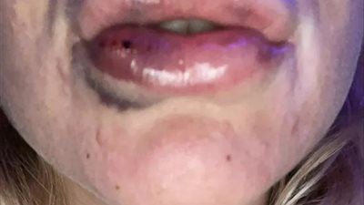 كأنها تعرضت لضرب مبرح.. بريطانية تحذر من شراء الفيلر عبر الإنترنت 