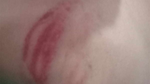 جانب من إصابات التلميذ