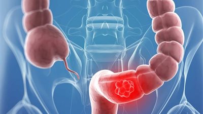 علاج القولون العصبي نهائيا.. حافظ على صحتك النفسية